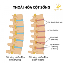 cac-trieu-chungthoai-hoa-cot-song-va-cac-phong-ngua